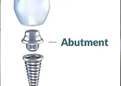 Implant Abutment Materials and Selection