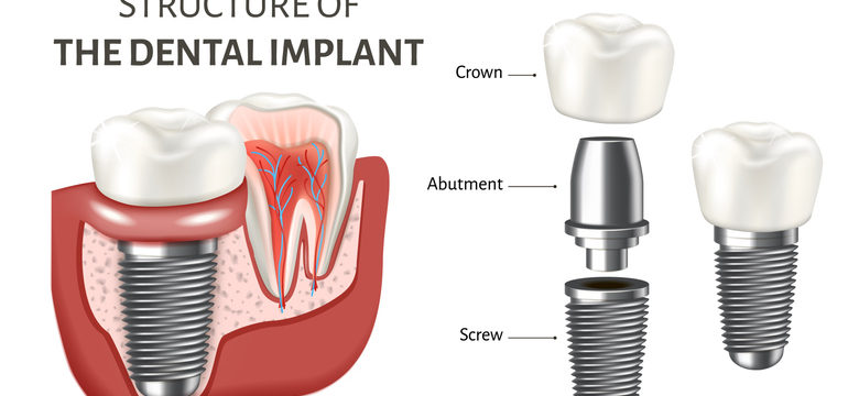 structure-of-dental-implants-780x360.jpg